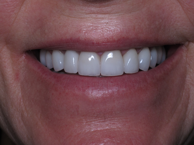 Porcelain Veneers Cost